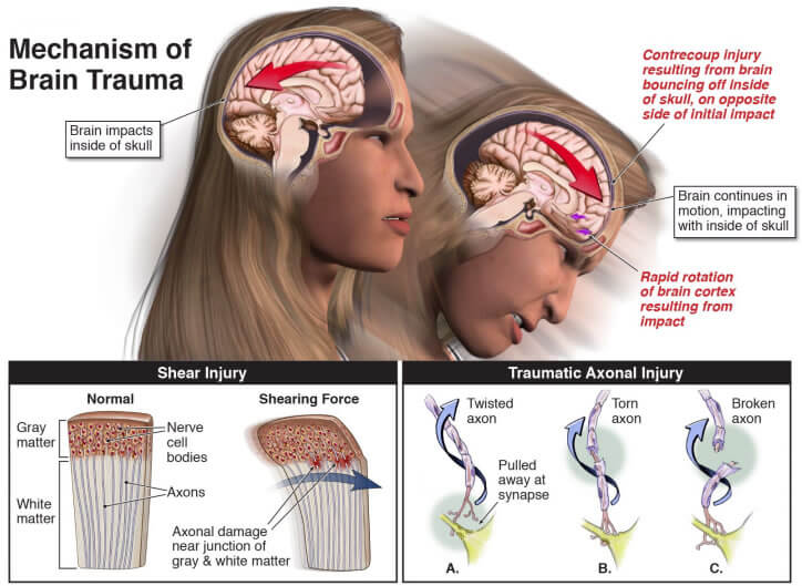 Diffuse Axonal Injury (DAI) Charlie Waters Law