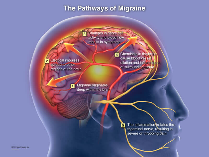 Pathways of Migraines