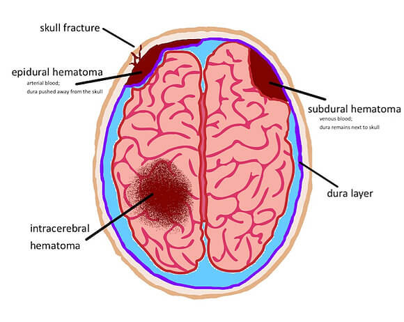 Brain Bruising (Hematomas) - Charlie Waters Law