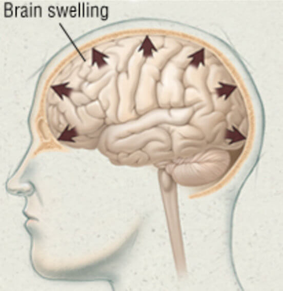 How do you treat brain swelling after stroke?